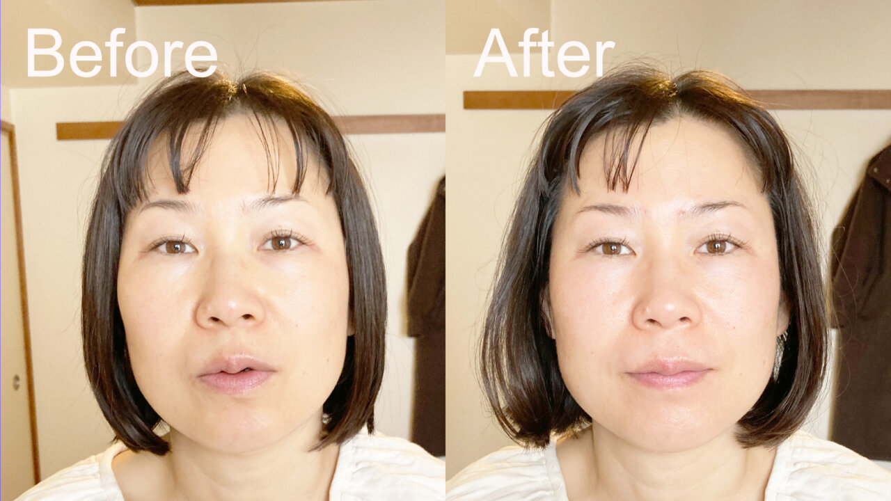 facial acupuncture - shinkoma_acupuncture_clinic