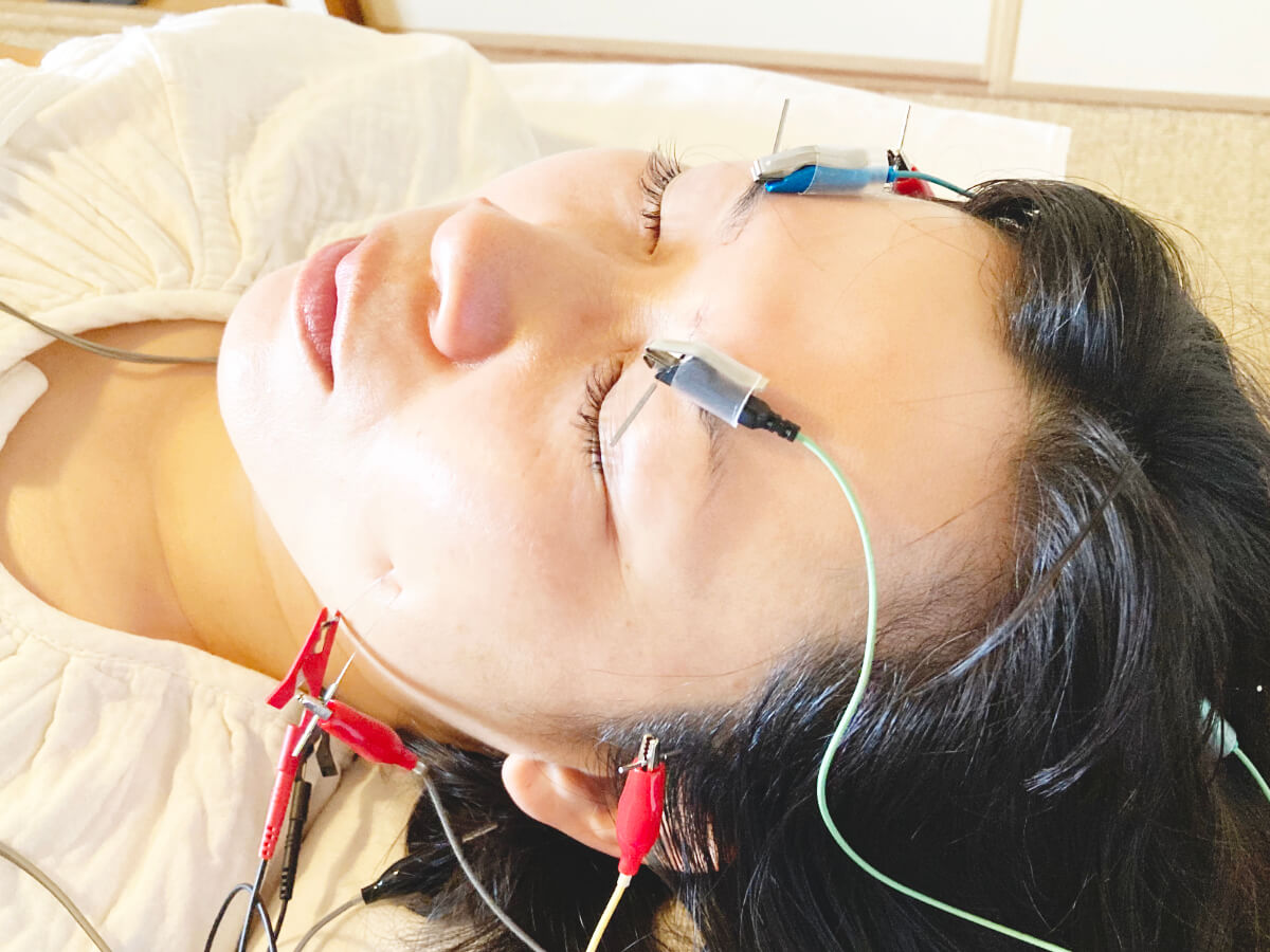 facial acupuncture - shinkoma_acupuncture_clinic
