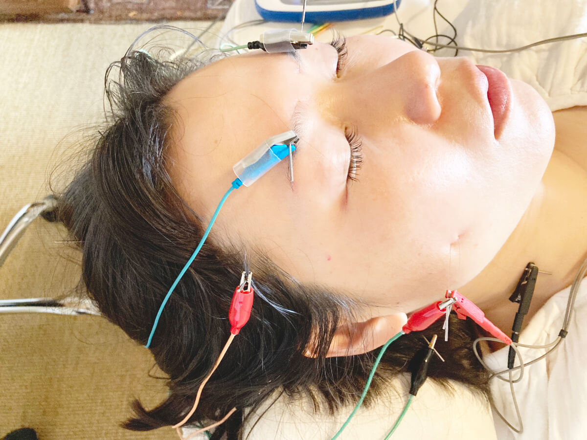 facial acupuncture - shinkoma_acupuncture_clinic
