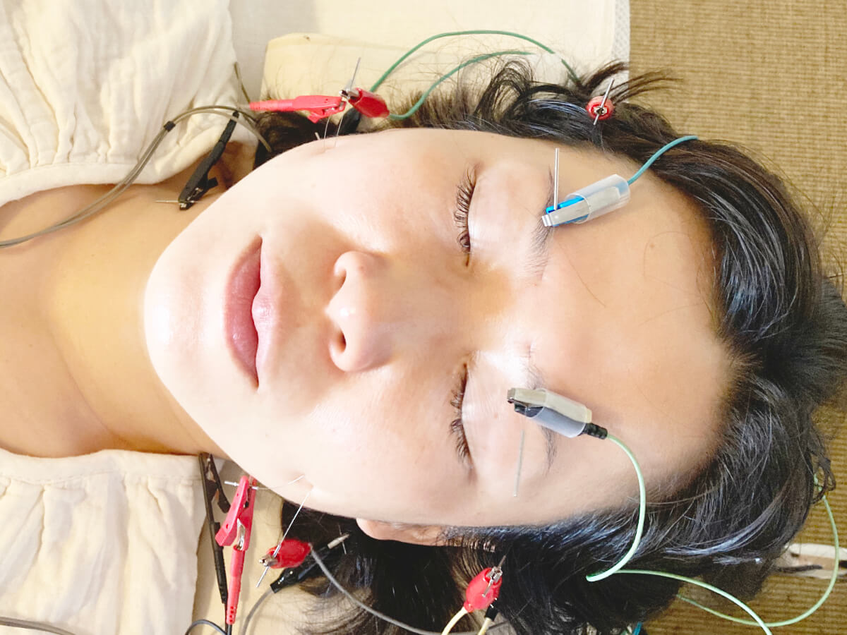facial acupuncture - shinkoma_acupuncture_clinic
